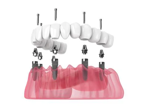 3d render of mandibular prosthesis all-on-6 system supported by implants Illustrazione stock