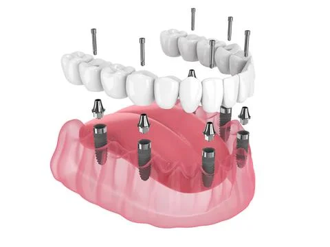 3d render of mandibular prosthesis all-on-6 system supported by implants Stock Illustration