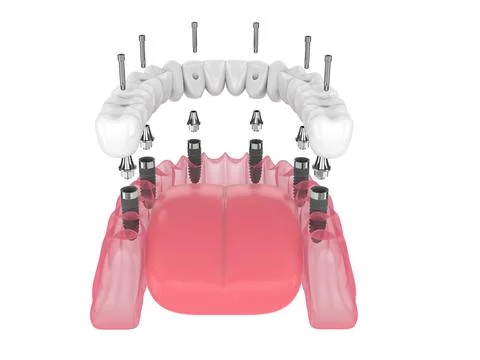 3d render of mandibular prosthesis all-on-6 system supported by implants Stock-Illustration