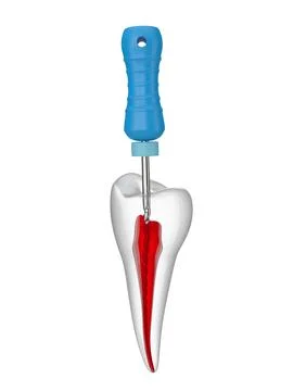 3d render of premolar tooth with endodontic C file over white background Stock-Illustration