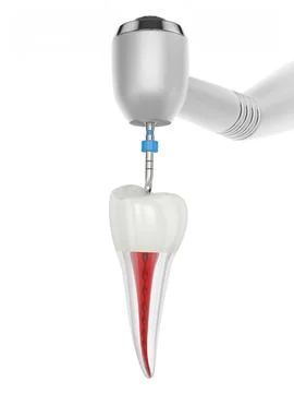 3d render of premolar tooth with handpiece and endodontic rotary file over .. Stock Illustration