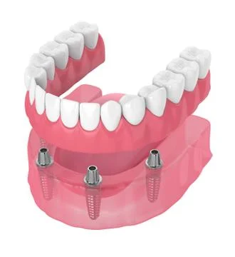 3d render of removable full implant denture Illustrazione stock