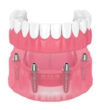 3d render of removable full implant denture Stock Illustration