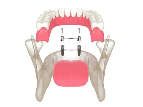 3d render of removable overdenture installation on bar clip attachment supp.. Stock-Illustration