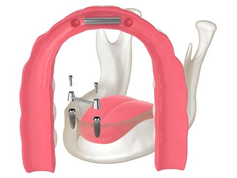 3d render of removable overdenture installation on bar clip attachment supp.. Stock Illustration