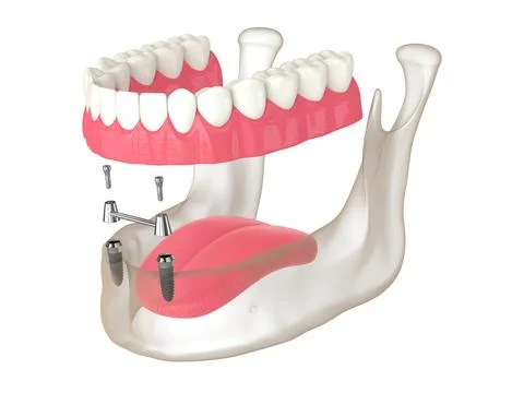 3d render of removable overdenture installation on bar clip attachment supp.. Stock Illustration