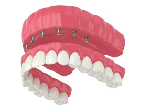 3d render of removable snap-on full implant denture installation Stock-Illustration