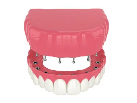 3d render of removable snap-on full implant denture installation Stock Illustration