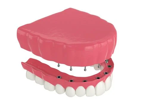 3d render of removable snap-on full implant denture installation Stock Illustration
