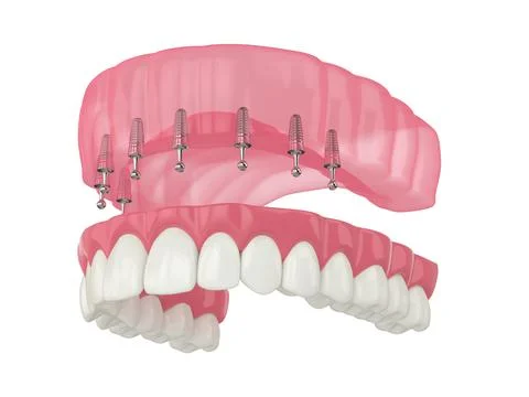 3d render of removable snap-on full implant denture installation Illustrazione stock