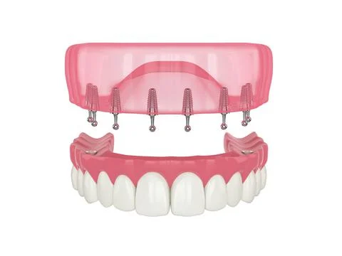 3d render of removable snap-on full implant denture installation Stock Illustration