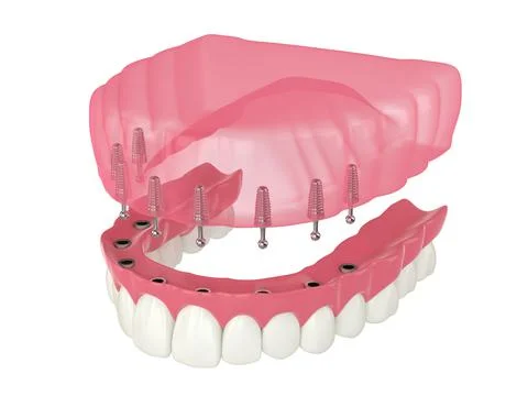 3d render of removable snap-on full implant denture installation Stock Illustration