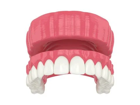 3d render of removable traditional denture installation Stock Illustration