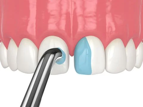 3d render of removing the mild acid as a part of bonding procedure Stock Illustration