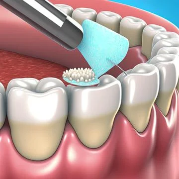 3d render of removing tartar and plaque from teeth by ultrasonic scaler. Dental Stock Illustration