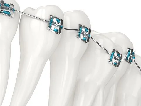 3d render of teeth alignment by orthodontic braces Stock Illustration