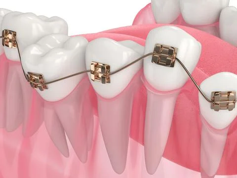 3d render of teeth alignment by orthodontic braces Stock Illustration
