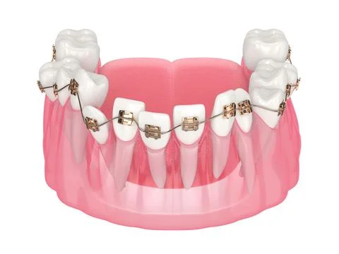 3d render of teeth alignment by orthodontic braces Stock Illustration