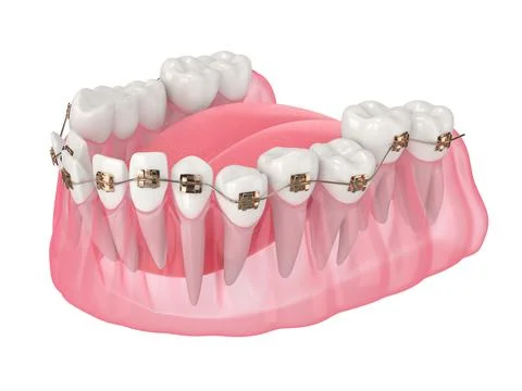 3d render of teeth alignment by orthodontic braces Stock Illustration