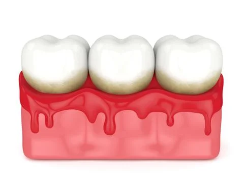 3d render of teeth in bleeding gums Stock Illustration