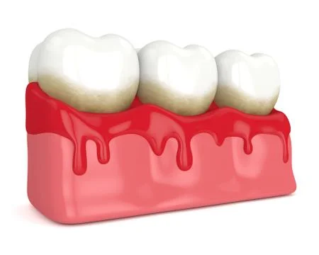 3d render of teeth in bleeding gums Illustrazione stock