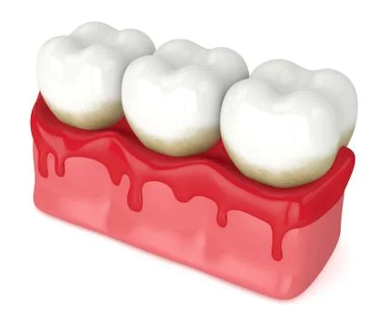 3d render of teeth in bleeding gums Stock Illustration