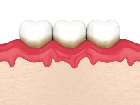 3d render of teeth in bleeding gums Stock Illustration