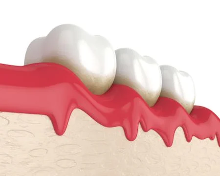 3d render of teeth in bleeding gums Stock Illustration