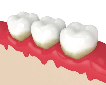 3d render of teeth in bleeding gums Illustrazione stock