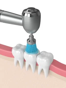 3d render of teeth with dental handpiece and polishing brush Stock Illustration