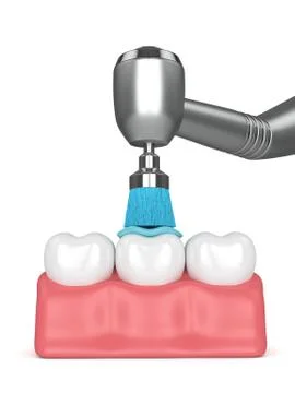 3d render of teeth with dental handpiece and polishing brush Illustrazione stock