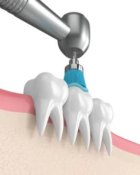3d render of teeth with dental handpiece and polishing brush Illustrazione stock