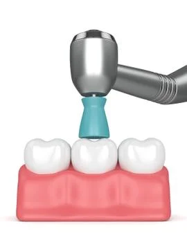 3d render of teeth with dental handpiece and polishing brush Stock-Illustration
