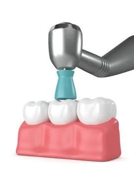3d render of teeth with dental handpiece and polishing brush Stock Illustration
