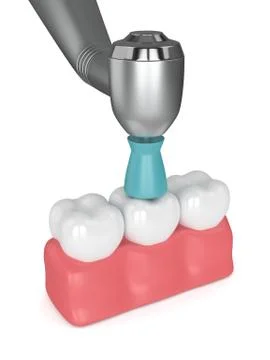 3d render of teeth with dental handpiece and polishing brush Stock Illustration