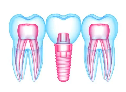 3d render of teeth with dental implant over white Stock Illustration