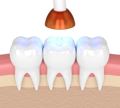 3d render of teeth with dental polymerization lamp and light cured inlay 스톡 사진