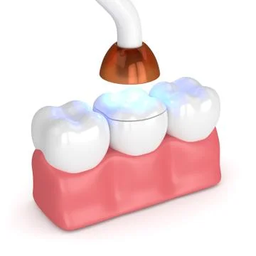 3d render of teeth with dental polymerization lamp and light cured onlay 스톡 사진