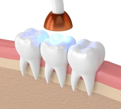 3d render of teeth with dental polymerization lamp and light cured onlay 스톡 사진