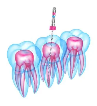 3d render of teeth with endodontic file over white background Stock Illustration