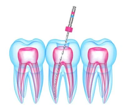 3d render of teeth with endodontic file over white background Stock Illustration