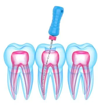 3d render of teeth with endodontic file over white background Illustrazione stock
