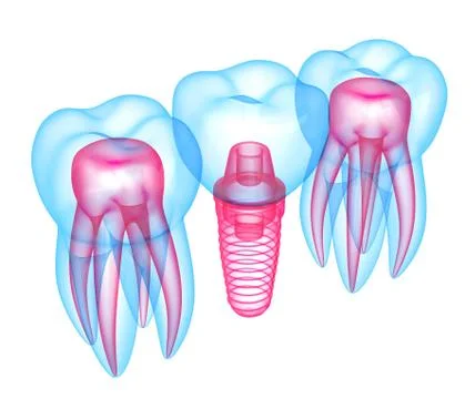 3d render of teeth with fiber post over white Stock Illustration