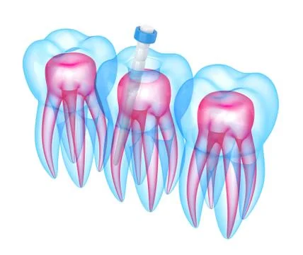 3d render of teeth with fiber post over white 스톡 사진