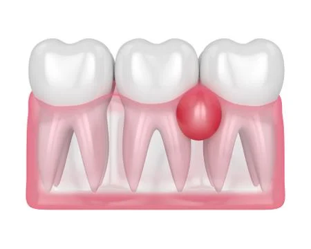 3d render of teeth in gums with cyst Stockillustratie