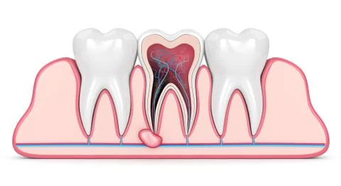3d render of teeth in gums with cyst Stockillustratie