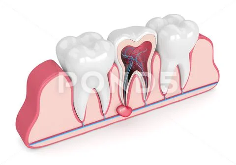 3d render of teeth in gums with cyst Illustration #131512088