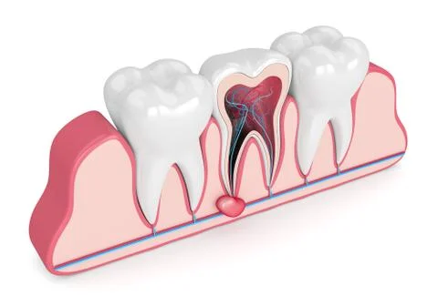 3d render of teeth in gums with cyst Stock Illustration