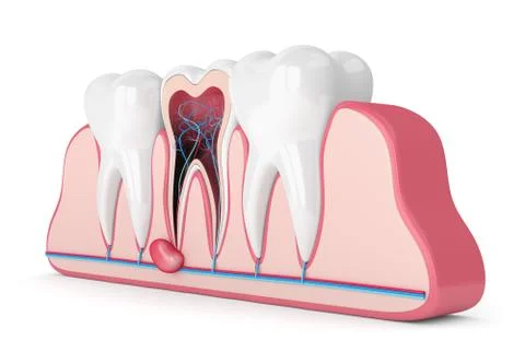 3d render of teeth in gums with cyst Stockillustratie