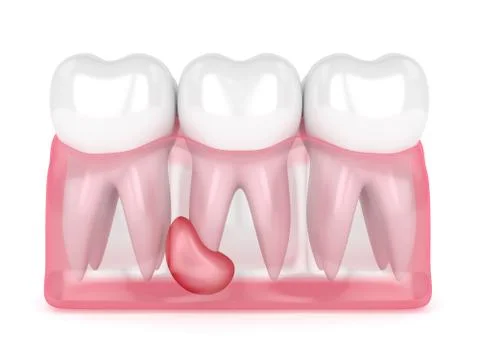 3d render of teeth in gums with cyst Stock Illustration